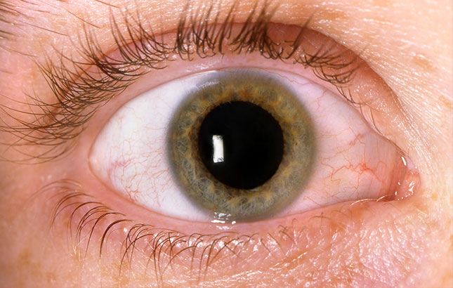 26 de maio, Dia Nacional de Combate ao Glaucoma: É provocada pela elevação da pressão ocular